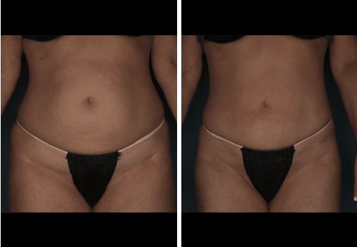 woman’s bare stomach before and after liposuction, stomach flatter after procedure