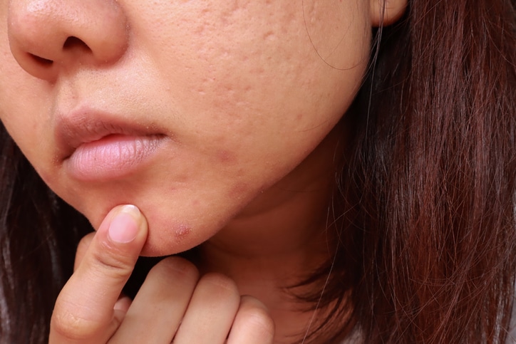 Pustules whitehead acne from face, Problems with acne and scar on the female skin, Skin problem stock photo