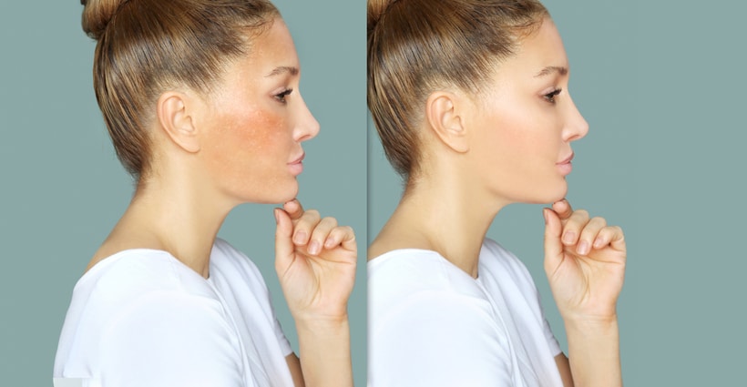 Dark spots, freckles,hyperpigmentation(melasma or chloasma),concept- skin lightening, skin whitening, Skin Brightening stock photo