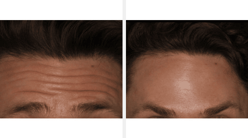 Botox/Xeomin before and after of a man that received injections to his forehead