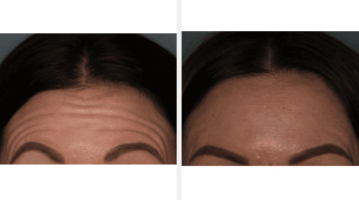 Botox/Xeomin before and after of a man that received injections to her forehead