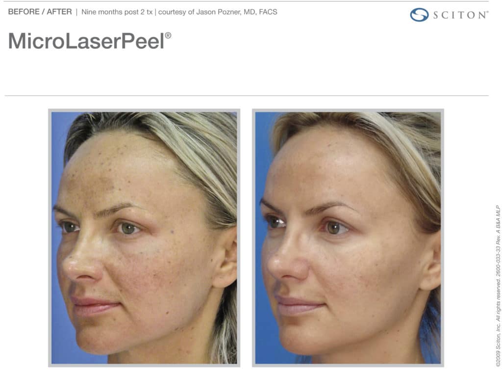 MicroLaser Peel Calgary AB Laser Treatments Calgary AB