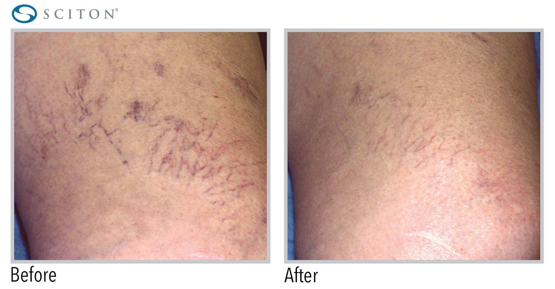 up close of veins on patient’s skin before and after laser treatment, faded afterwards