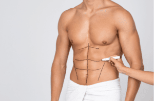 Mans Fit Torso With Surgical Lines On His Body Before Operation.