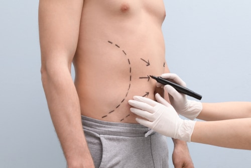 Doctor drawing lines on mans stomach with marker 1