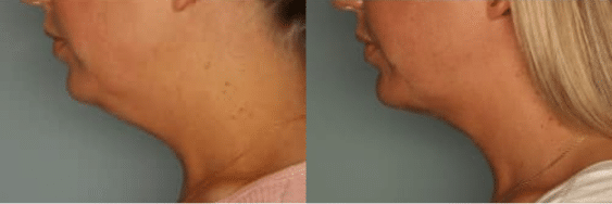 side view of woman’s chin before and after Belkrya, chin more defined after injection