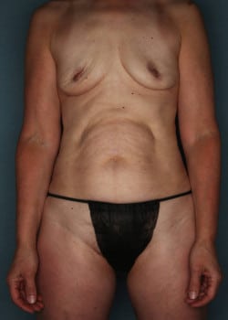 Breast Augmentation with Abdominoplasty & Liposuction