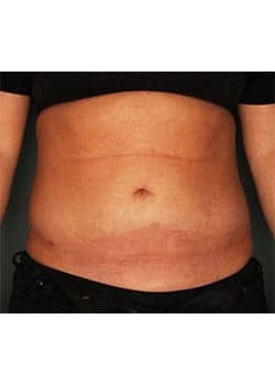 Liposuction To Abdomen
