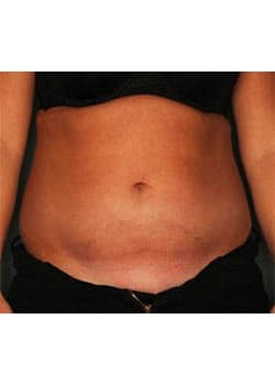 Liposuction To Abdomen