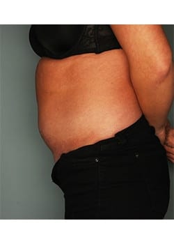 Liposuction To Abdomen