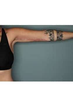 Arm Lift with Liposuction