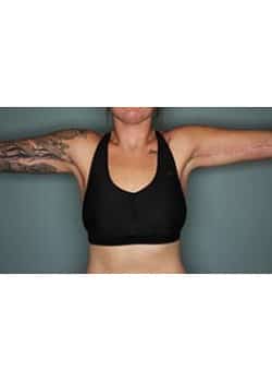 Arm Lift with Liposuction