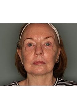 Facelift, Necklift and Corset Platysmaplasty