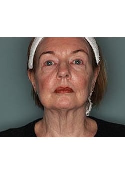 Facelift, Necklift and Corset Platysmaplasty