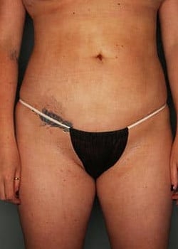 Liposuction with Fat Graft to the Buttocks