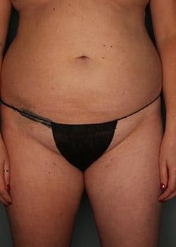Liposuction with Fat Graft to the Buttocks