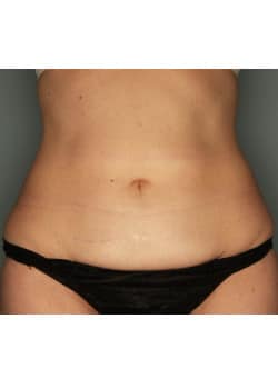 CoolScuplting to the Lower Abdomen
