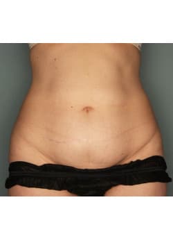 CoolScuplting to the Lower Abdomen