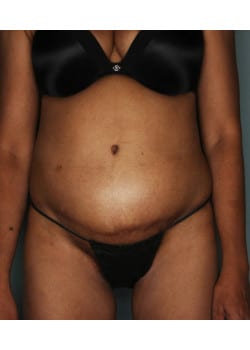 Abdominoplasty with Liposuction – Before & After – 3