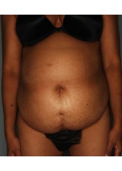 Abdominoplasty with Liposuction – Before & After – 3