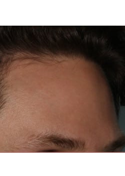 Botox/Xeomin for the Forehead – Before & After – 1