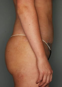 Brazilian Butt Lift
