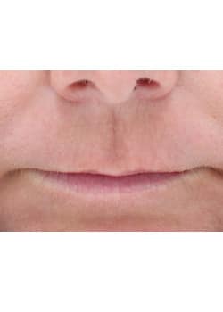 Laser Skin Resurfacing