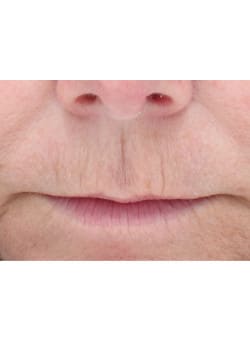 Laser Skin Resurfacing