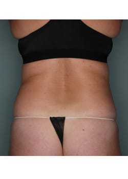 Liposuction to Upper and Lower Abdomen, Flanks and Hips