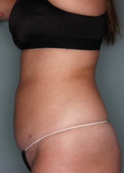 Liposuction to Upper and Lower Abdomen, Flanks and Hips