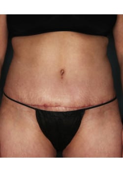Abdominoplasty with Liposuction – Before & After – 3