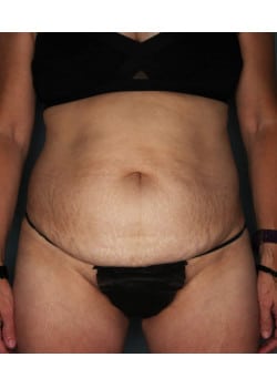 Abdominoplasty with Liposuction – Before & After – 3