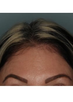 Botox/ Xeomin for the Forehead – Before & After – 3