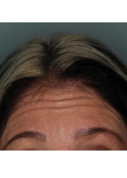 Botox/ Xeomin for the Forehead – Before & After – 3