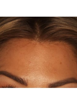 Botox/ Xeomin for the Forehead – Before & After – 2
