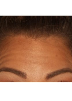 Botox/ Xeomin for the Forehead – Before & After – 2
