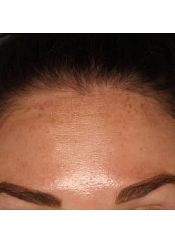 Botox/ Xeomin for the Forehead