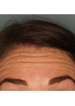 Botox/ Xeomin for the Forehead