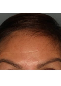 Botox/ Xeomin for the Forehead – Before & After – 4