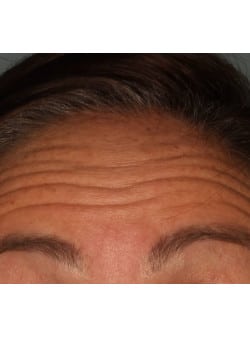 Botox/ Xeomin for the Forehead – Before & After – 4
