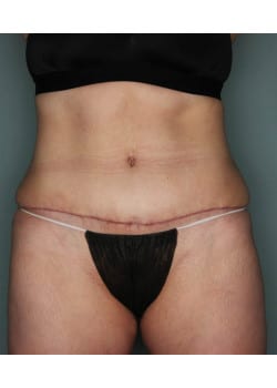 Abdominoplasty with Liposuction – Before & After – 4