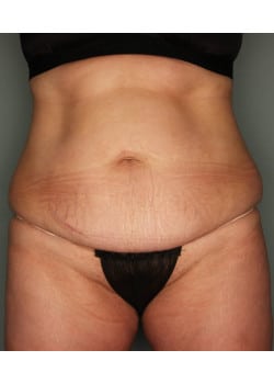 Abdominoplasty with Liposuction – Before & After – 4