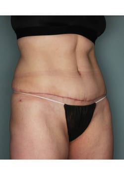 Abdominoplasty with Liposuction – Before & After – 4