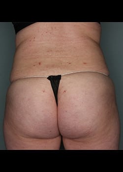 Brazilian Butt Lift