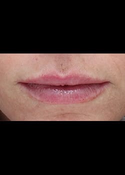 Dermal Filler for the Lips