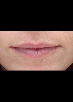 Dermal Filler for the Lips