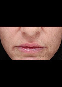 Dermal Filler for the Lips