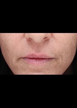 Dermal Filler for the Lips