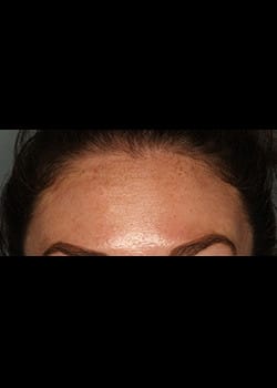Botox (Xeomin) for the Forehead – Before & After – 5