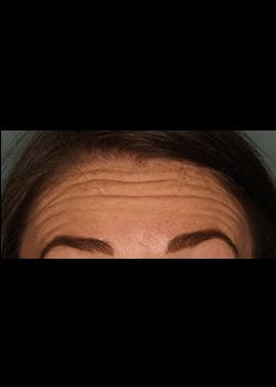 Botox (Xeomin) for the Forehead – Before & After – 5
